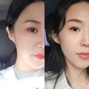 필약국 | 논현역 귀필러 부작용없는 큐티필 필러 후기