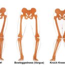 내반슬(Varus), 외반슬(Valgus) 이미지