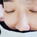 강자안손톱 이미지