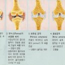 류마티스 관절염(Rheumatoid Arthritis) | 건강상식 이미지