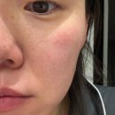 메디보니 | 메디톨드연구소 악시크림 공구솔직후기[내돈내산]