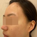 제산한의원 | 여드름 약국 연고 후기 비추하는 이유도 알려드려여