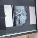 고운부부치과의원 | 교정상담에만 100만원들인 교정시작 후기! 연세고운미소치과 인천점!(인비절라인, 클리씨피, 설측교정...