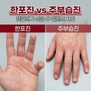 사암부천한의원 | 부천한포진 치료 , 한포진 vs 주부습진 헷갈리기 쉬운 두 질환의 차이