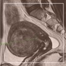 신의료기 | 자궁근종 임신할때 지장있을까?