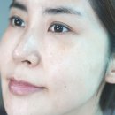 웨이브 | 청라 피부과 옆볼꺼짐 채우는 콜라겐부스터 힐로웨이브 후기