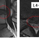 퍼팩트 님의 요추디스크 L4-5의 MRI 사진 판독입니다. 이미지