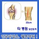퇴행성관절염을 해결하자. 무릎통증/무릎퇴행성관절염/무릎수술 이미지
