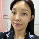 덕천피부과 리쥬란HB 2cc 내돈내산 상세후기