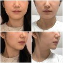 핏모아 | 수원 인계동 피부과 : 세모아의원 | 티타늄리프팅 + 슬림핏주사 일주일 후기, 효과, 통증, 다운타임