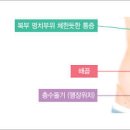 맹장 위치 맹장염 초기증상 통증 치료 방법 이미지