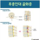 디스크인 줄 알았는데 뜻밖에 '후종인대 골화증', 사지마비될 수 있다고? 이미지