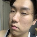 센 | 화농성 여드름 흉터 일본 약 혼소겐 이소페린 퀘르센 먹은 후기