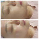 포항 문덕 피부관리 김지효피부연구소 수분 탄력관리 슈퍼젝션 후기