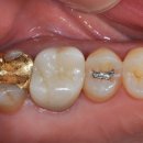 오케이치과의원 | [의왕시 치과] "살려야 한다!" 발치 위기의 치아, 임플란트 대신 자연치아 살린 1년 후기 (치근우식증)