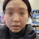 메이퓨어의원 | [김포 장기동] 한관종, 편평사마귀 제거 후기, 합리적인 가격의 메이퓨어 의원