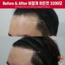 지실 | 남자 모발이식후기 결과 비교의 포인트는