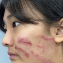 타미성형외과의원 | 흉터 제거 시술 6회차 6️⃣