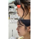 압구정서울성형외과의원 | 압구정성형외과 들창코, 낮은코 고민 해결 자연스러운 코 성형 수술 후기