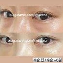 하하약국 | 20대 눈밑지방재배치 수술 후기 • 내돈내산 후기 • 혼자 수술하고오기