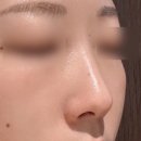 청담고등학교 | 청담 코 필러 후기, 코 필러 유지기간, 비포애프터