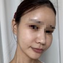 오로라핑크 | 부산 피부과 핑크오로라주사 2차 후기