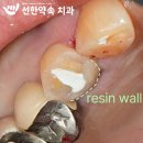밥 먹다가 치아 깨졌다면? 광주 선한약속 치과 에서 발치하지 않고 신경치료 후 크라운 한 케이스