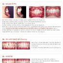 치아교정 case, 치아교정 장치의 종류 이미지