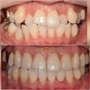 미사센트럴치과의원 | 미사역치과 임플란트와 교정을 동반한 40대 여성의 환골탈태 전체적인 치료 후기