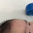 손주약국 | 대전 연어반 치료 레이저 후기 1차 : 우리 애기 잘했어