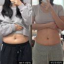 멍＃ | 대전 지방분해주사 비용 복부 시술 멍 후기