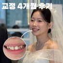 안하2 | 포항 남구 성인 덧니 교정 1~4개월차 후기 : 결혼 3개월 전 냅다 교정한 여성