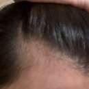 헤어닥터 | 정수리탈모치료 고민 해결, 닥터토비아 카페인 헤어인핸싱 폼 후기
