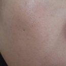 첨단기업5로1L-21 | 리메드, REFTONE 레프톤, 논써멀 재생 리프팅, 충격파 에너지, 시술 후기