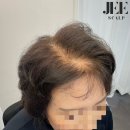 지스칼프