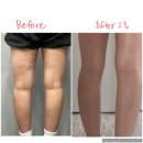 강남역피부과에서 바디온다 시술로 허벅지 셀룰라이트 없앤 후기