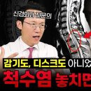 디스크도 아닌데 다리 힘이 빠져요 놓치기 쉬운 병 척수염 절대 그냥 넘기면 안 됩니다 이미지