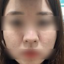 서울메이피부과의원 | [서울]상암 메이퓨어의원 피코프락셀+리비힐후기(상암피부과|상암피코프락셀|상암리비힐)