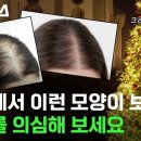 모힐의원 | 머리에서 이런 모양이 보이면 탈모를 의심해 보세요