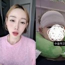 김별 | '이숙캠' 김별 눈썹 뼈 및 이마 축소 수술 후기, 달라진 얼굴 라인과 회복 과정의 모든 것