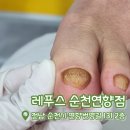 연향번영길 | [레푸스 순천연향점]광양내성발톱 | 순천발톱무좀 | 광양발관리