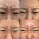 (주)메타뷰 | 국산 보톡스 내성 없는 전후 후기 눈가 이마 미간 광대 측두근 턱 보톡스 까지