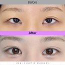 아이컨텍성형외과의원 | 쌍수 후 비대칭 눈매, 재수술로 대칭 교정한 후기 (하니성형외과)