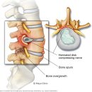 Spinal stenosis 척추관협착과 활기법 이미지