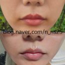 엄피부과의원 | [레디어스 내돈내산] 레디어스 콜라겐주사 1회 | 팔자주름 | 레디어스 후기 | 여의도 피부과