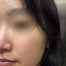 민의원 | 강남구청역피부과 민클리닉, 쥬베룩스킨 찐 후기 전후 효과