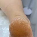 문제성 손, 발 오감네일 이미지