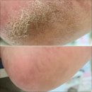 수봉공원 (관리실) | 인천 남동구 구월동 간석동 만수동 발각질 관리 No.1 에이풋케어 내성발톱 발톱무좀 발각질 문제성발