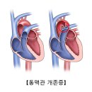 동맥관 개존증(Patent ductus arteriosus) 소아청소년질환, 순환기질환이란? 이미지