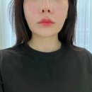 입암동이런맛에온다 | 신논현피부과 온다리프팅+윤곽주사+스킨보톡스 후기